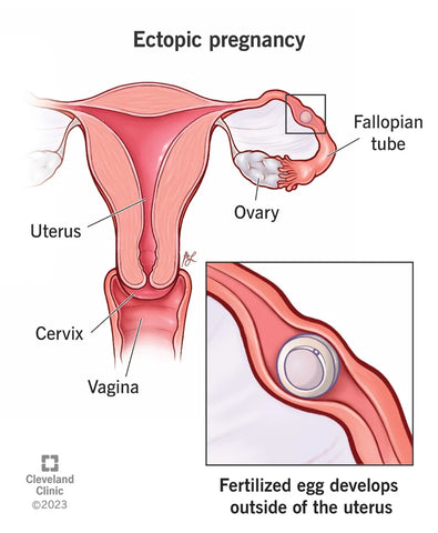Ectopic Pregnancy - The Cleveland Clinic